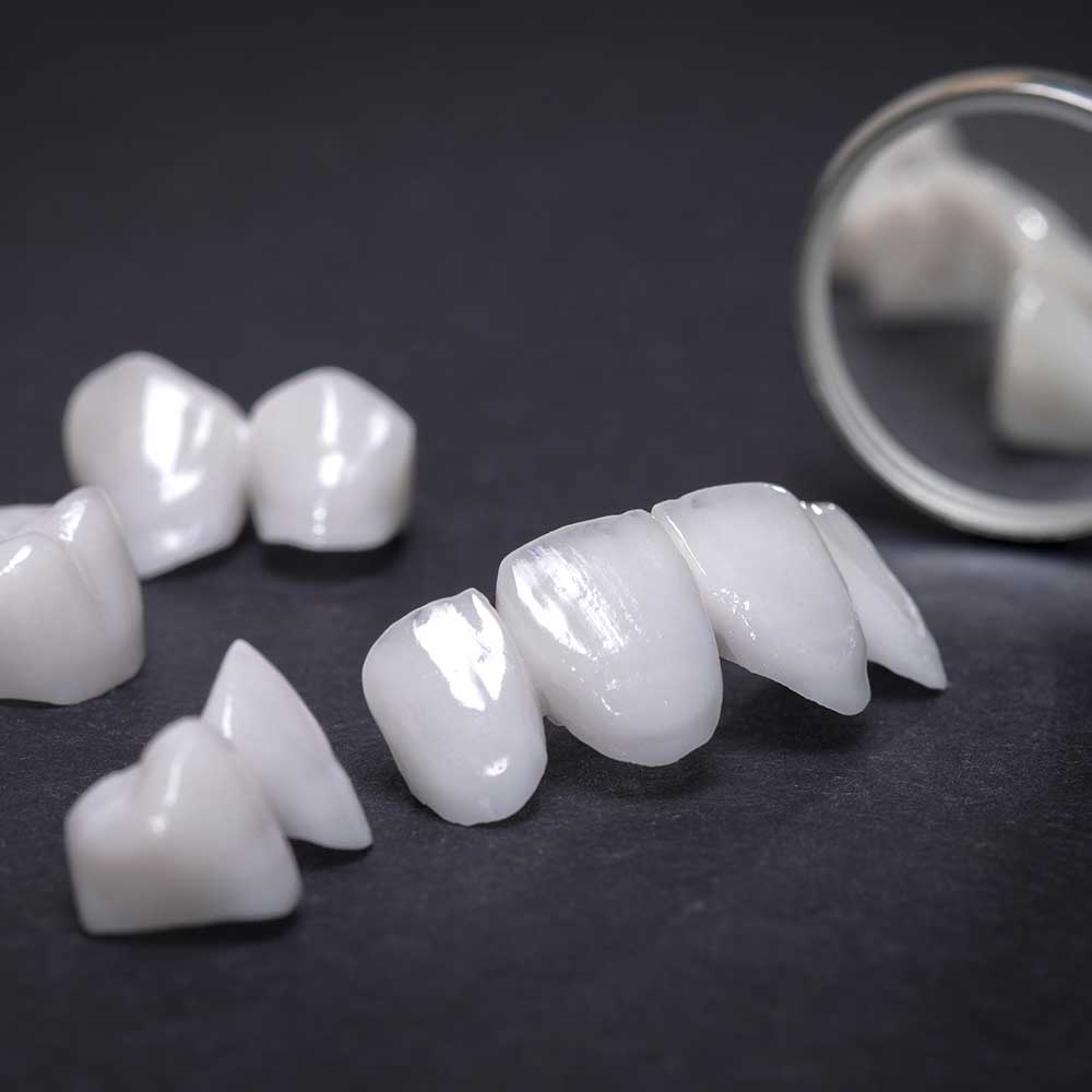 veneers_zahnarzte